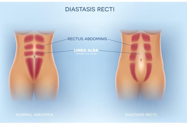 What Non-Surgical Options Are Available for Diastasis Recti Watford?
