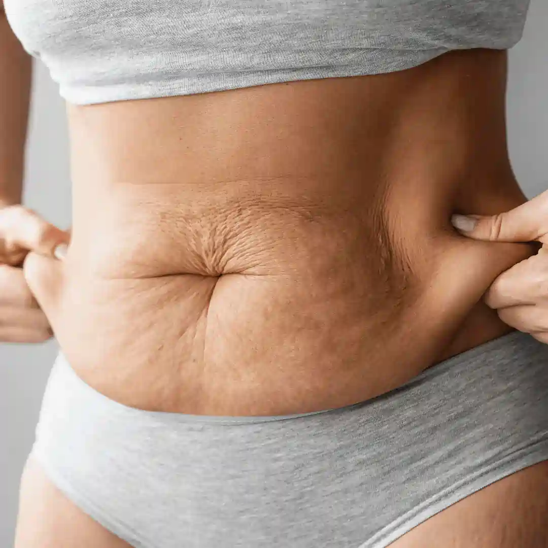 Is It Normal to Have Loose Skin After Pregnancy Watford?
