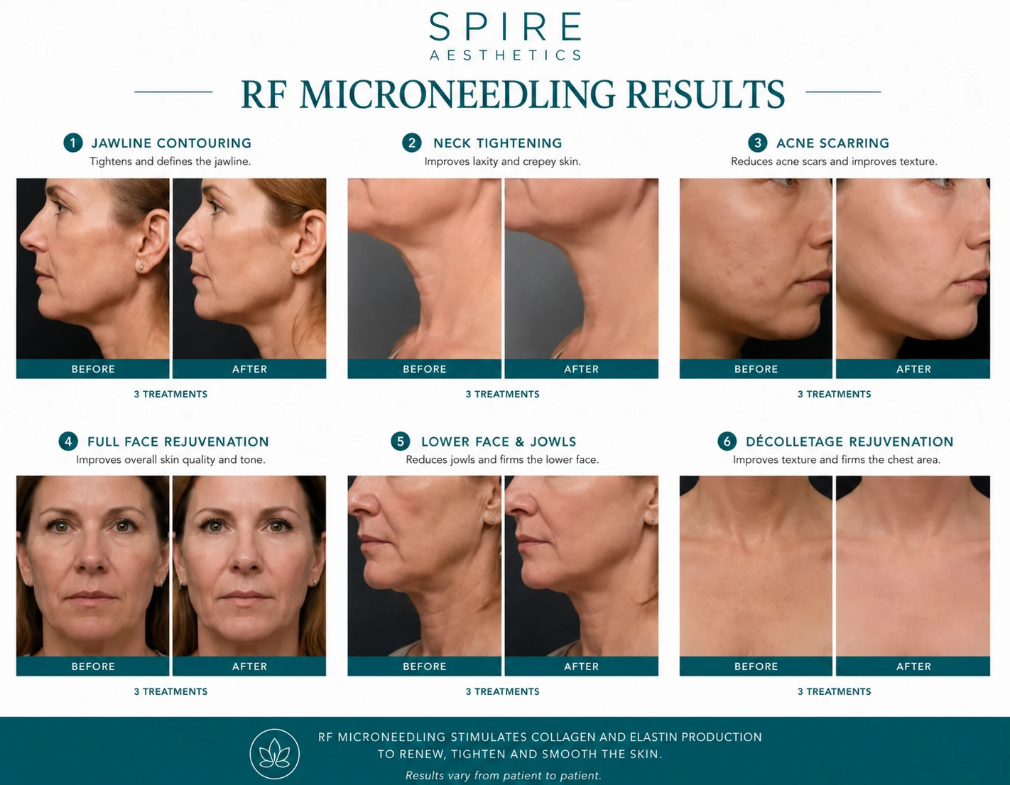 RF Microneedling Skin tightening Watford results