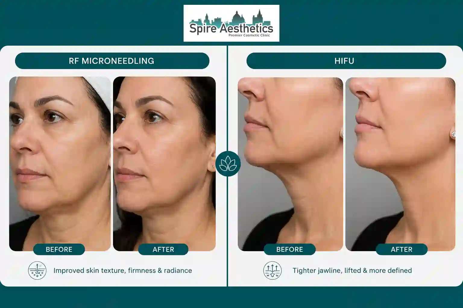 Can RF Microneedling and HIFU Be Combined Watford?