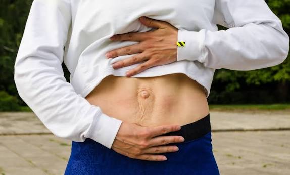 When Could Diastasis Recti Be the Missing Piece of the Puzzle Watford?