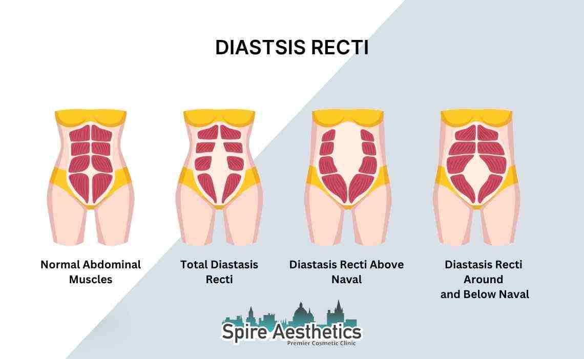 Is Non-Surgical Diastasis Recti Treatment Right for You? Common Concerns Answered Watford